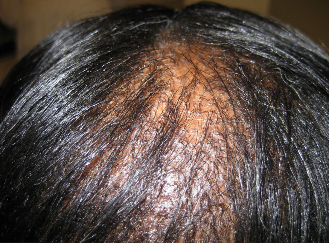 Benefits of a Scalp Message